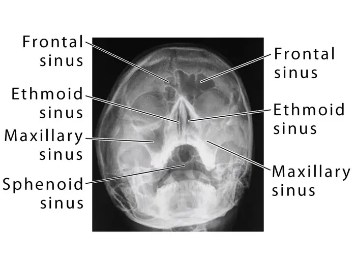 Paranasal Sinus Definition Location Anatomy Function Picture